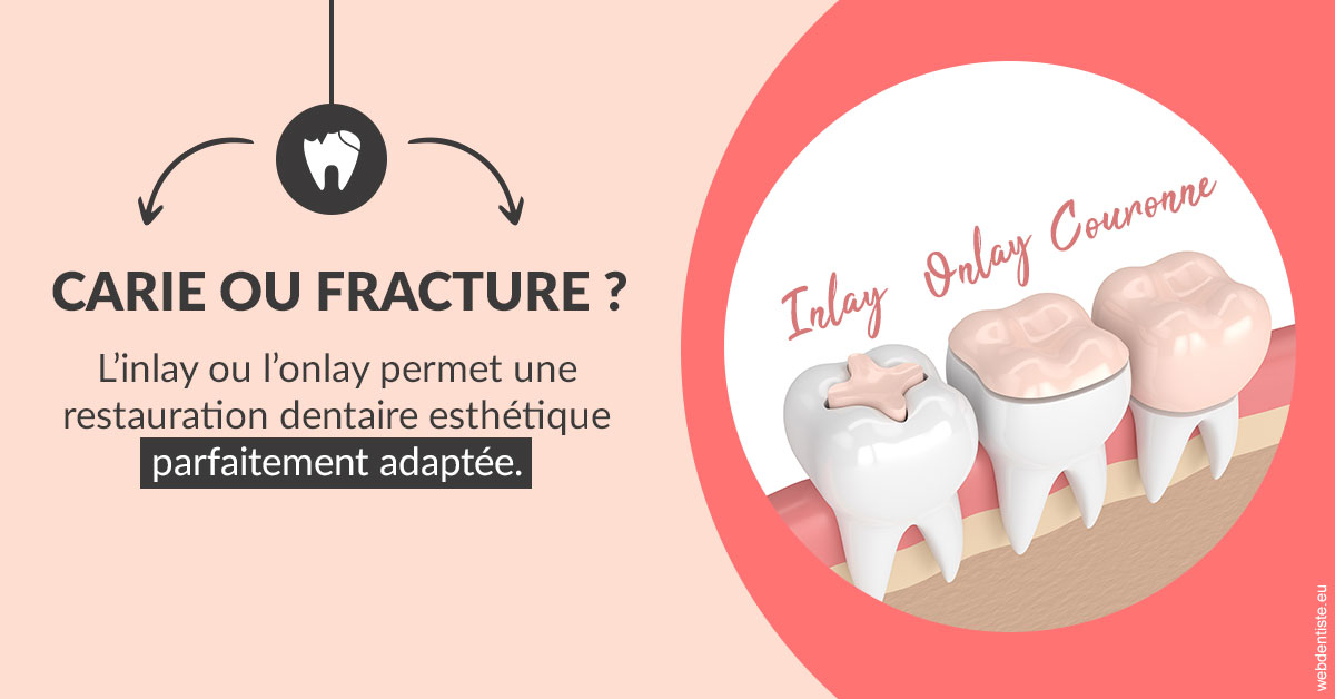 https://dr-lambert-philippe.chirurgiens-dentistes.fr/T2 2023 - Carie ou fracture 2