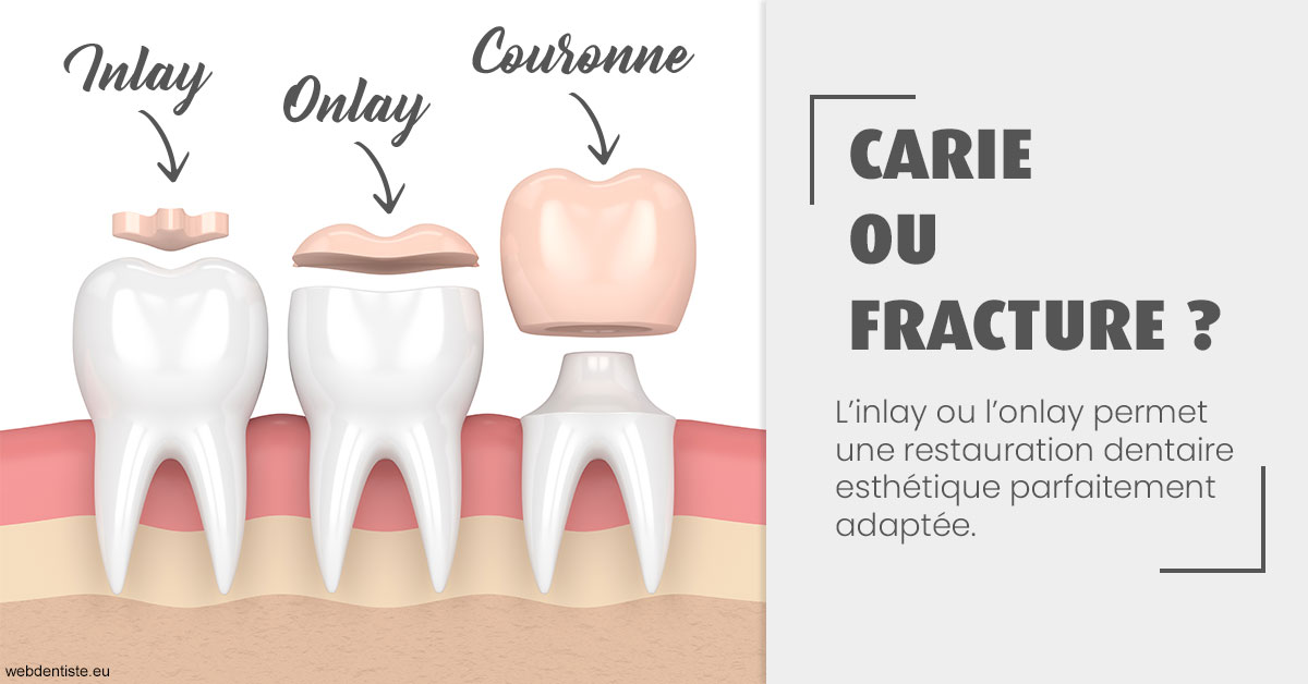 https://dr-lambert-philippe.chirurgiens-dentistes.fr/T2 2023 - Carie ou fracture 1