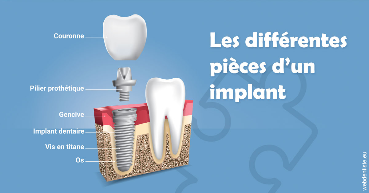 https://dr-lambert-philippe.chirurgiens-dentistes.fr/Les différentes pièces d’un implant 1